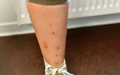 Blog - Informations sur les punaises de lit 11 Lien entre les punaises de lit et les allergies