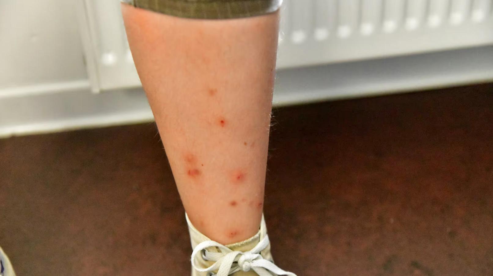 Blog - Informations sur les punaises de lit 11 Lien entre les punaises de lit et les allergies